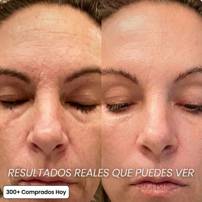 Transforma Arrugas, Líneas Finas y Pliegues de Cansancio de Forma Natural
