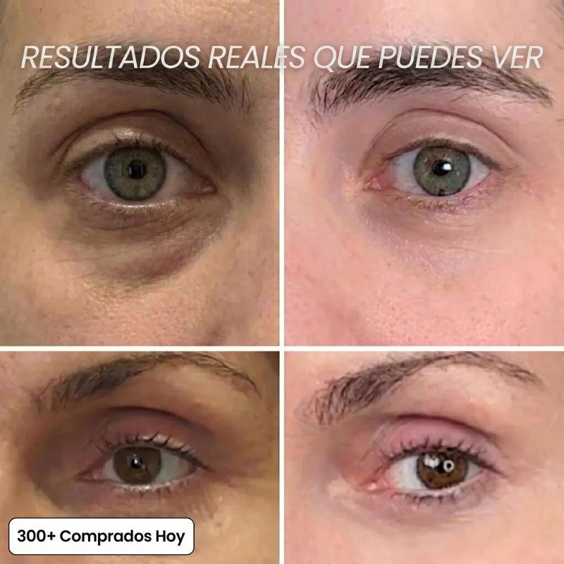 Transforma Arrugas, Líneas Finas y Pliegues de Cansancio de Forma Natural