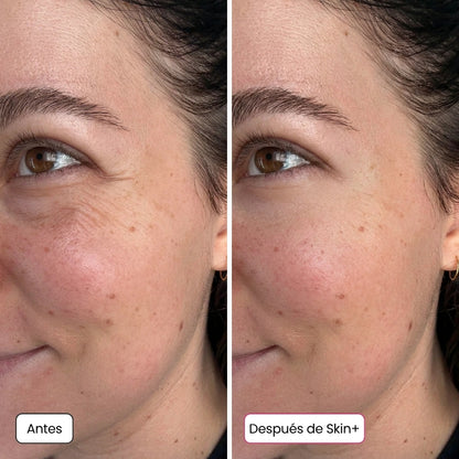 Micro-infusión coreana 5 en 1 - Resultados desde la 1.ª aplicación